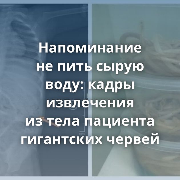 Напоминание не пить сырую воду: кадры извлечения из тела пациента гигантских червей